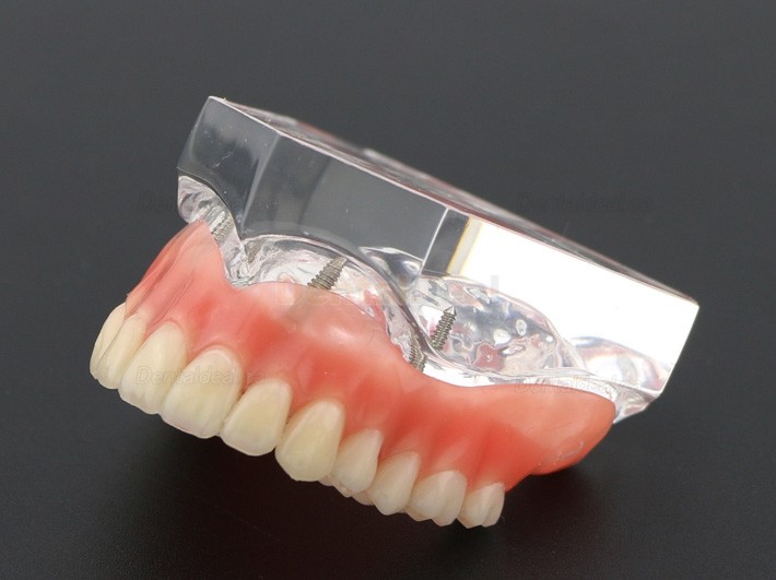 Dental Teeth Implant Overdenture Model Upper Jaw With 4 Implants Study Demo Model 6001